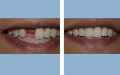 Before and After